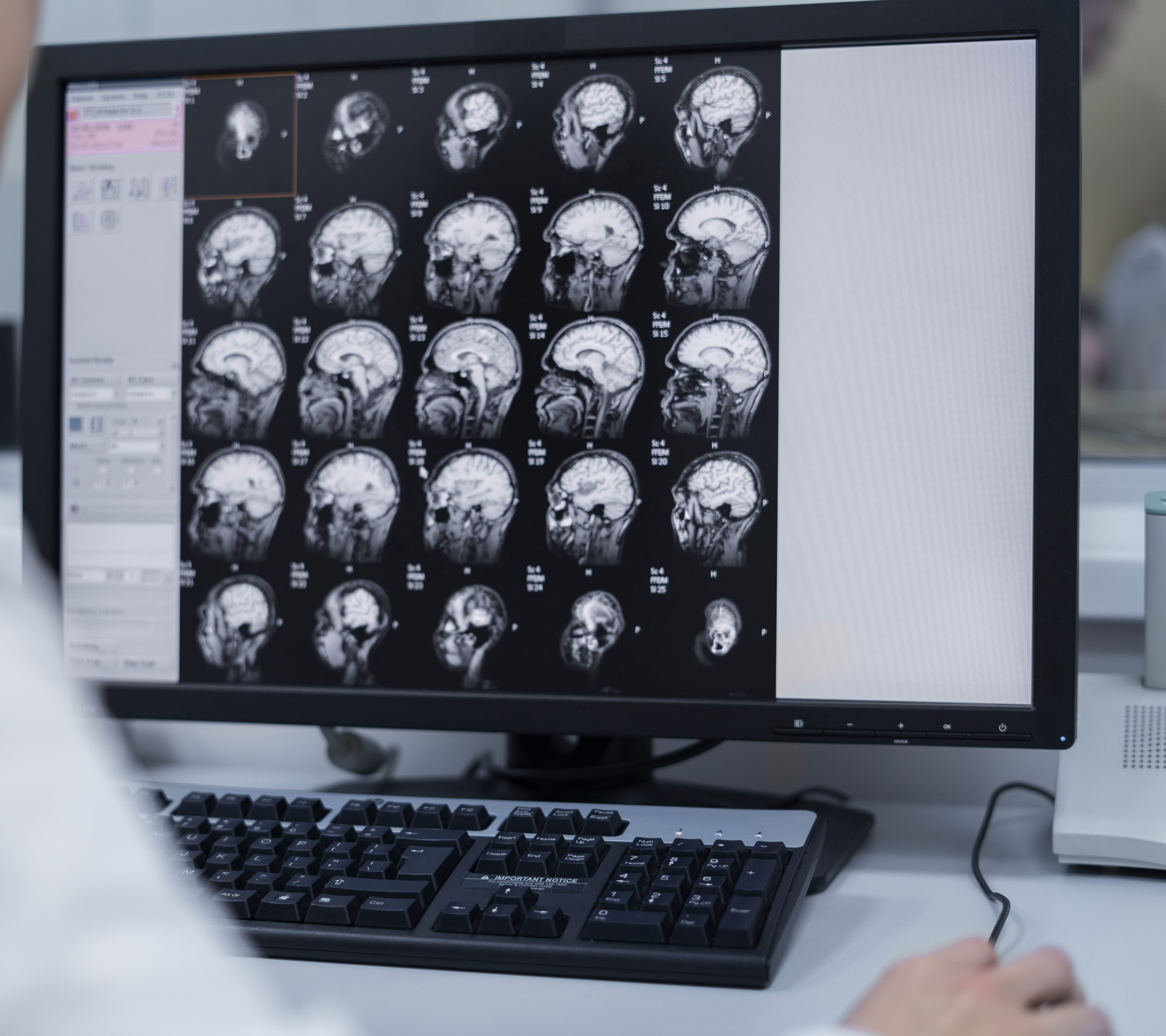 Picture showing brain scans on a computer to show an example of how brain injuries are diagnosed