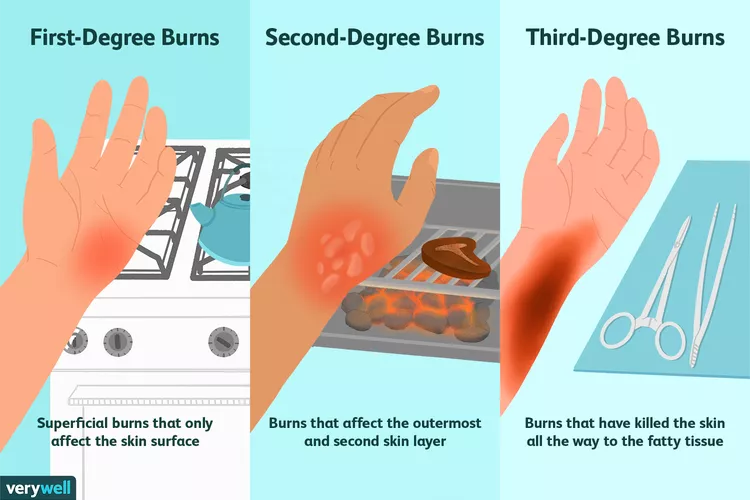 First Degree Burns - Superficial burns that only affect the skin surface. 
Second Degree Burns - Burns that affect the outermost and second skin layer. 
Third Degree Burns - Burns that have killed the skin all the way to the fatty tissue.